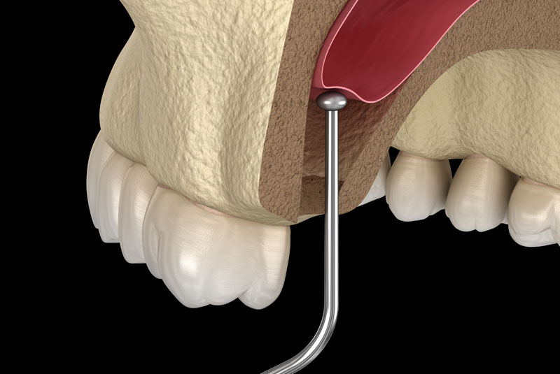 sinus lift graphic