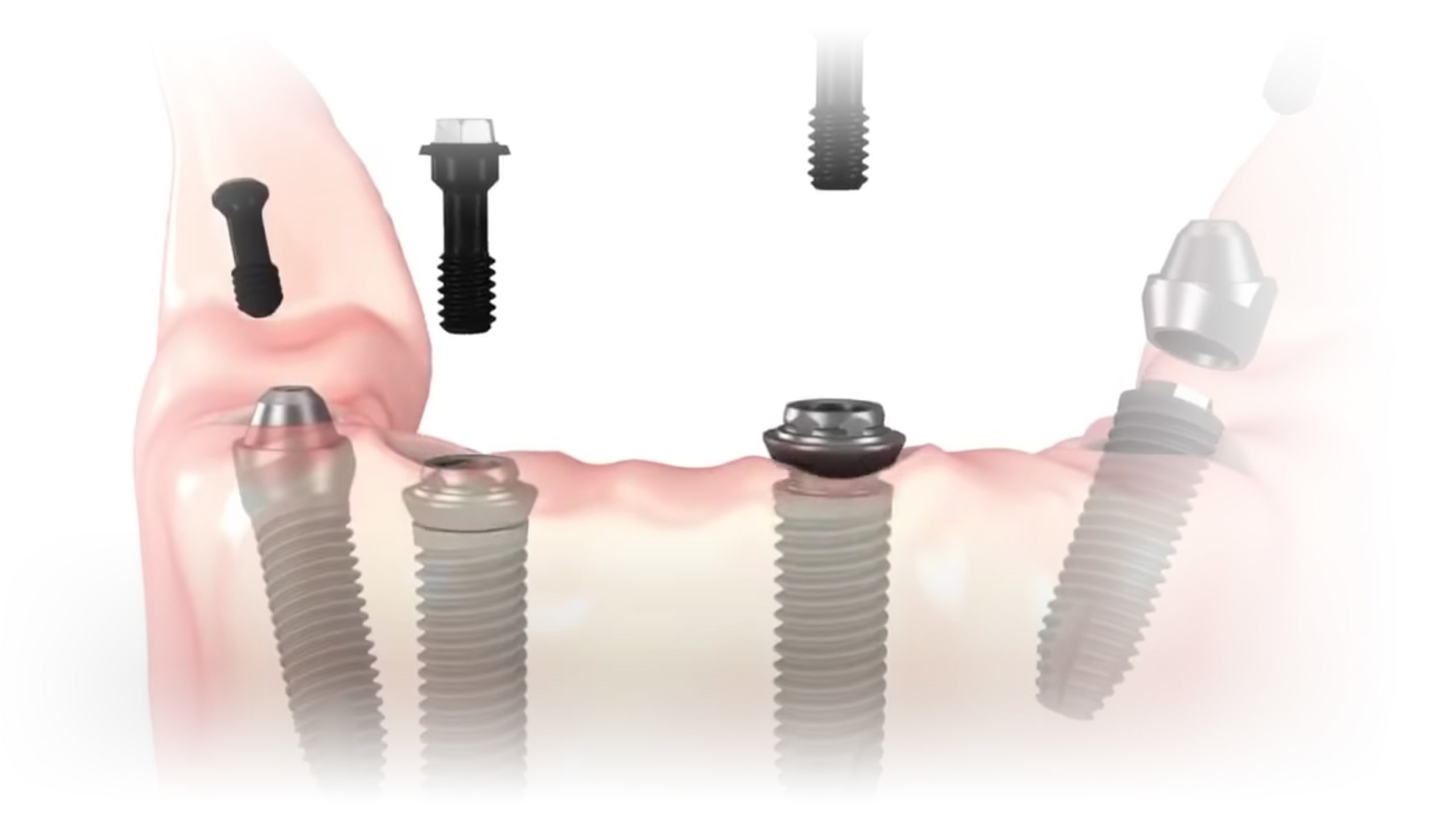 All-On-4 Implant Supported Dentures in Pensacola, FL