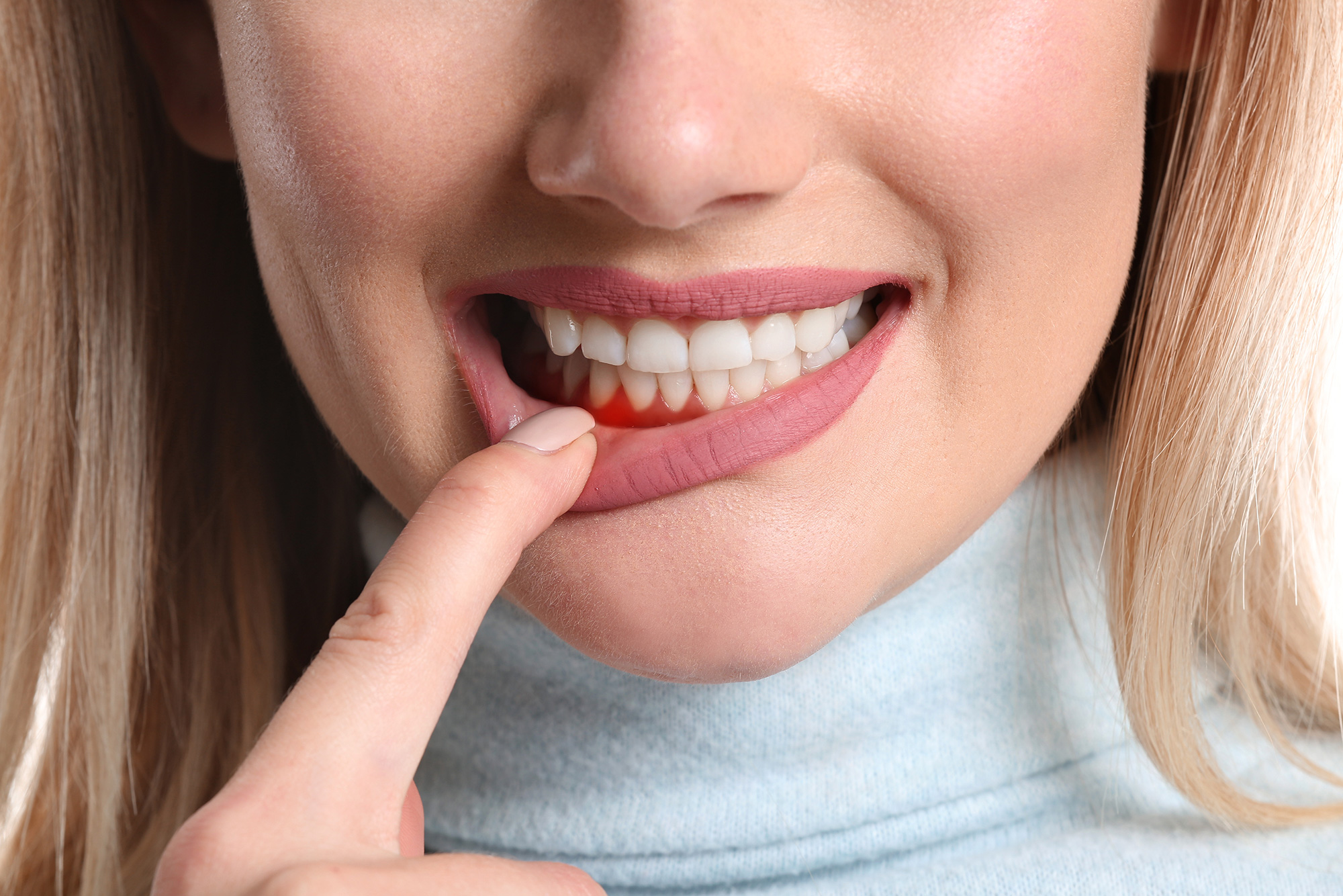 How to Prevent and Treat Bleeding Gums