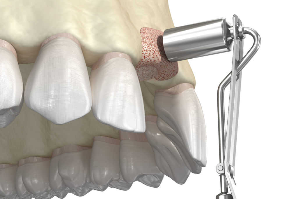 Bone Graft Pensacola Periodontics and Implant Dentistry Pensacola, FL