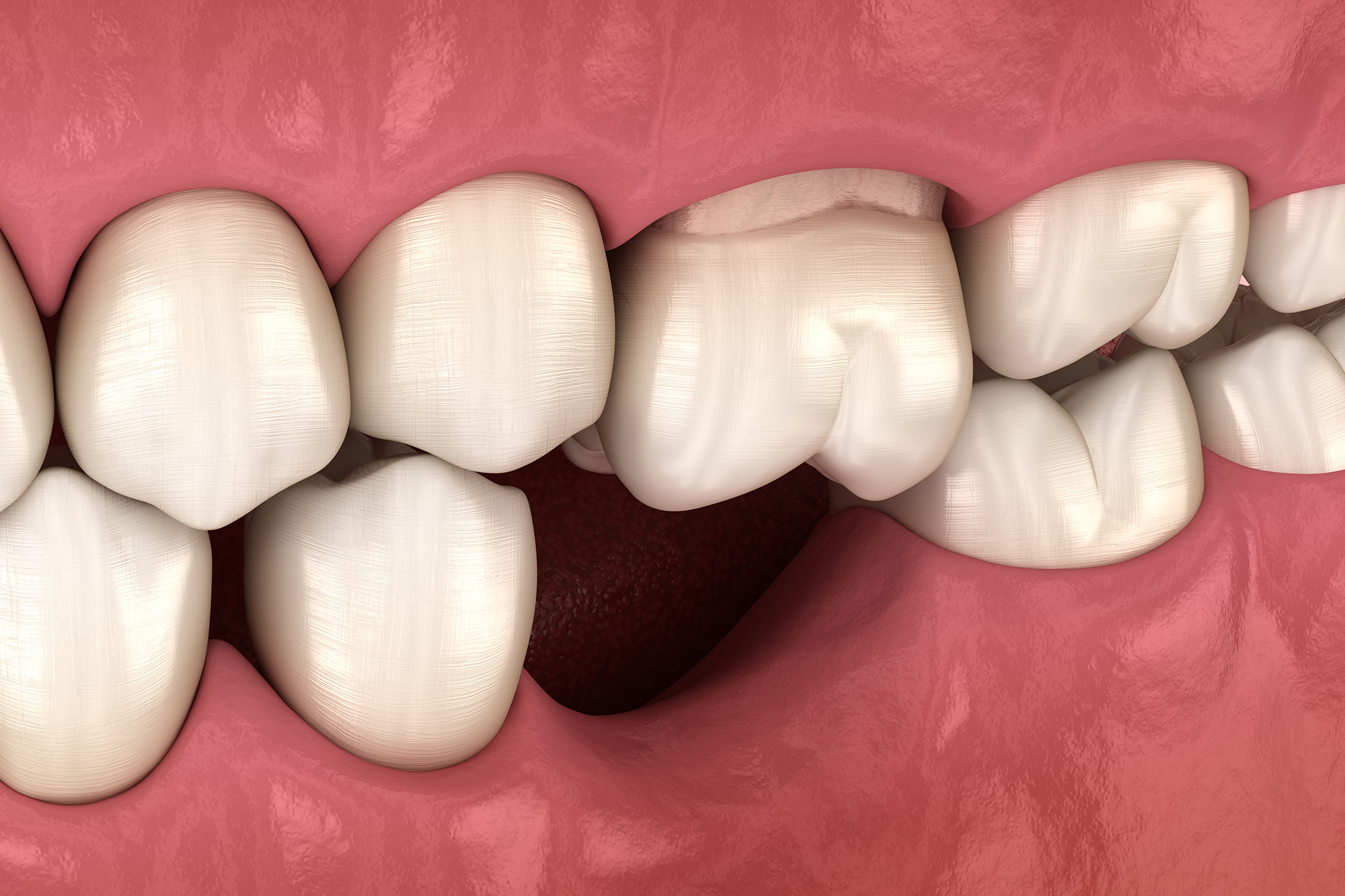 Tooth and Bone Loss Pensacola Periodontics and Implant Dentistry Pensacola, FL