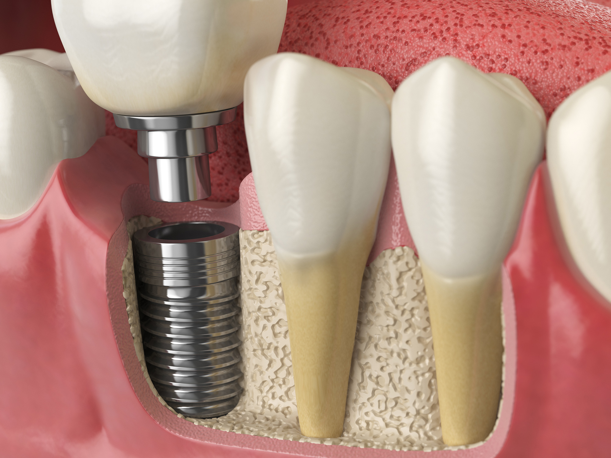 Dental implants Pensacola Periodontics and Implant Dentistry Pensacola, FL
