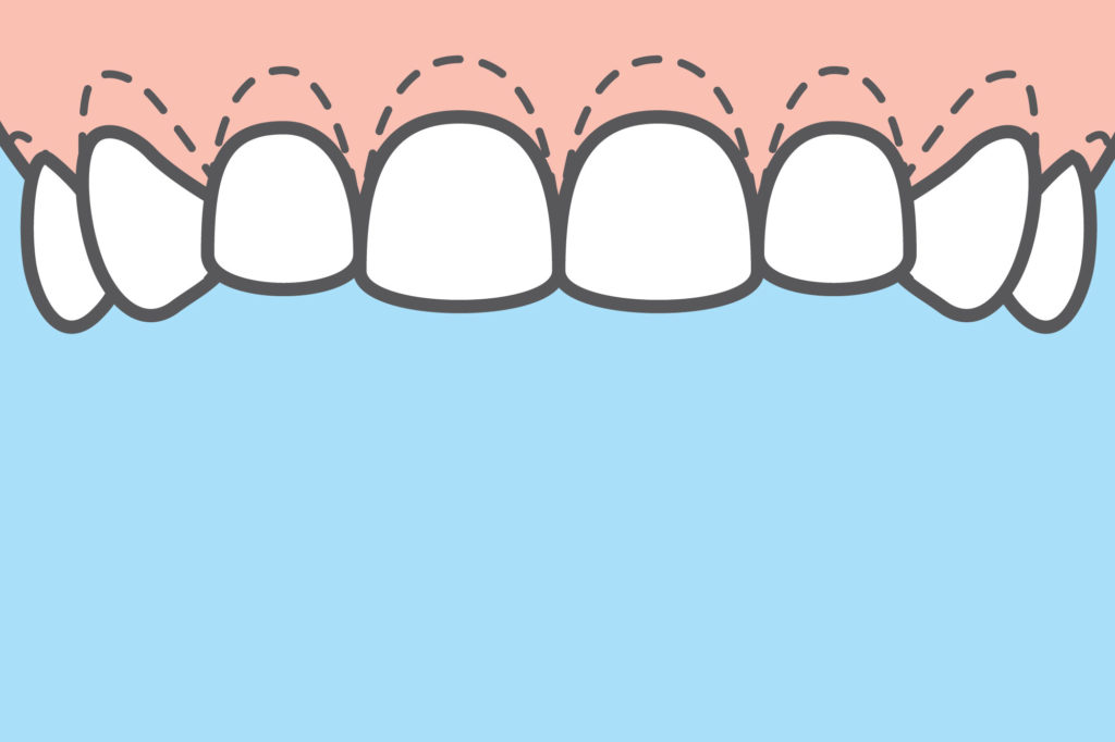 Periodontal Plastic Surgery