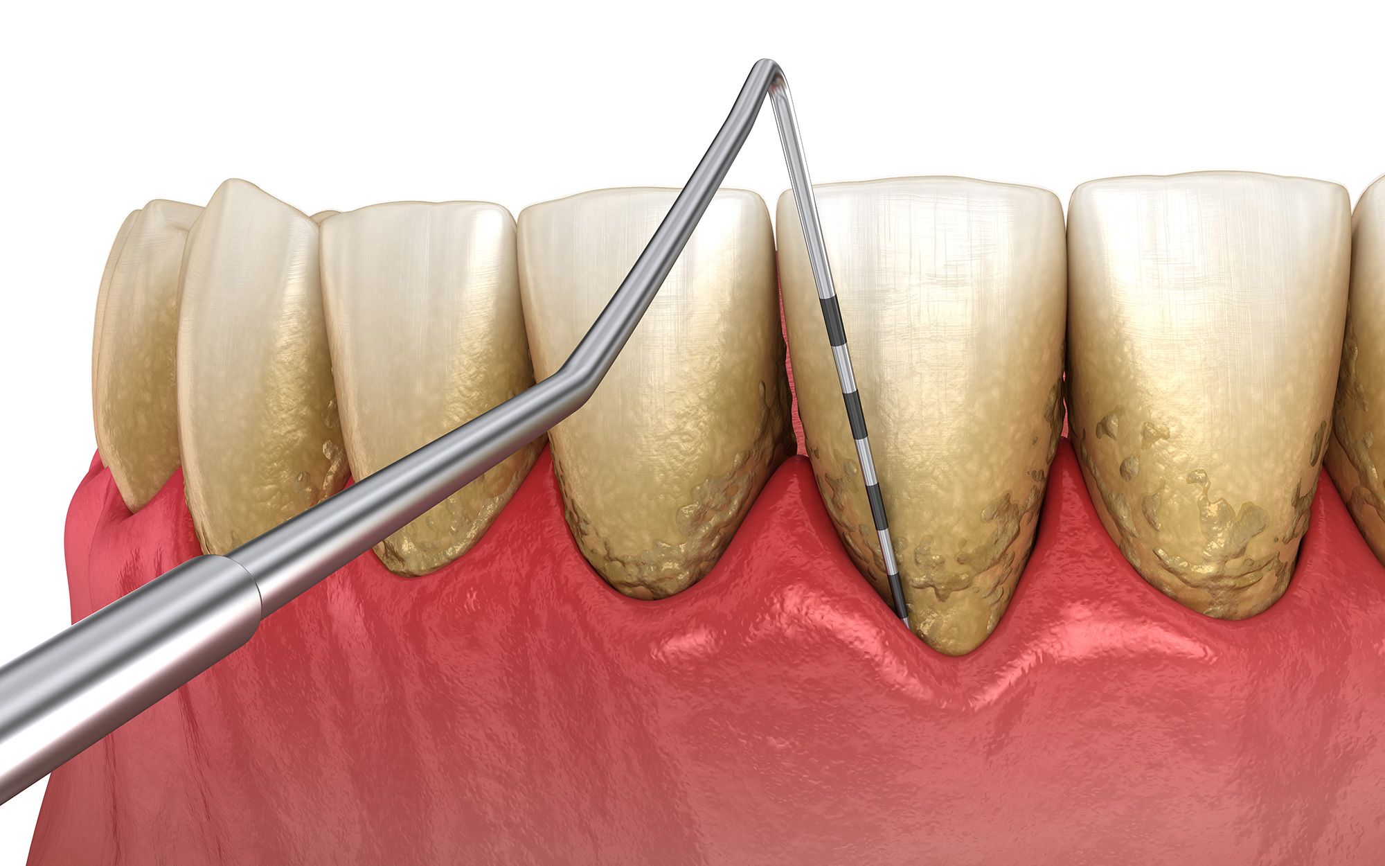 Gum Recession Pensacola Periodontics and Implant Dentistry Pensacola, FL