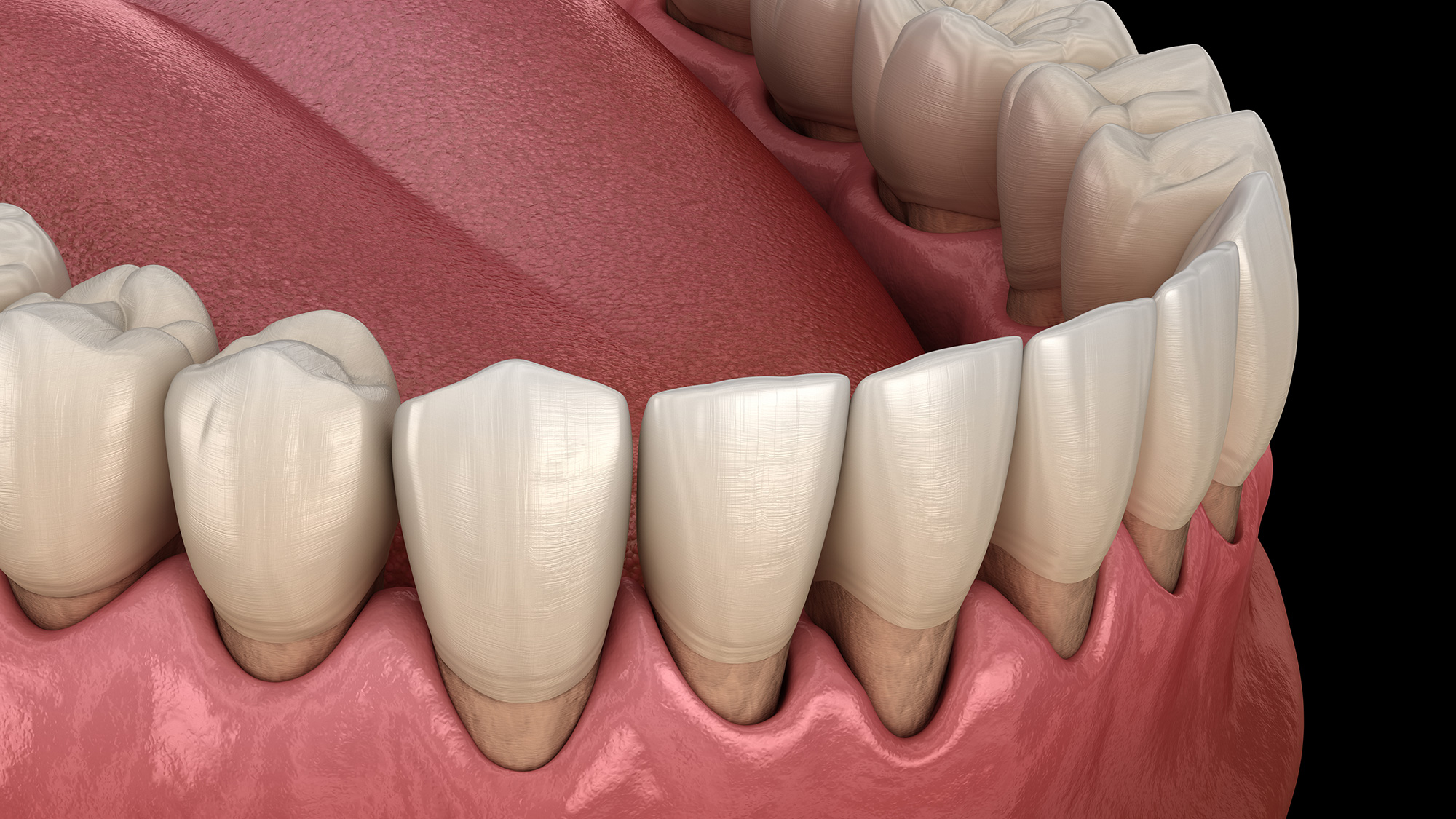 Gum Recession Causes Pensacola Periodontics and Implant Dentistry Pensacola, FL