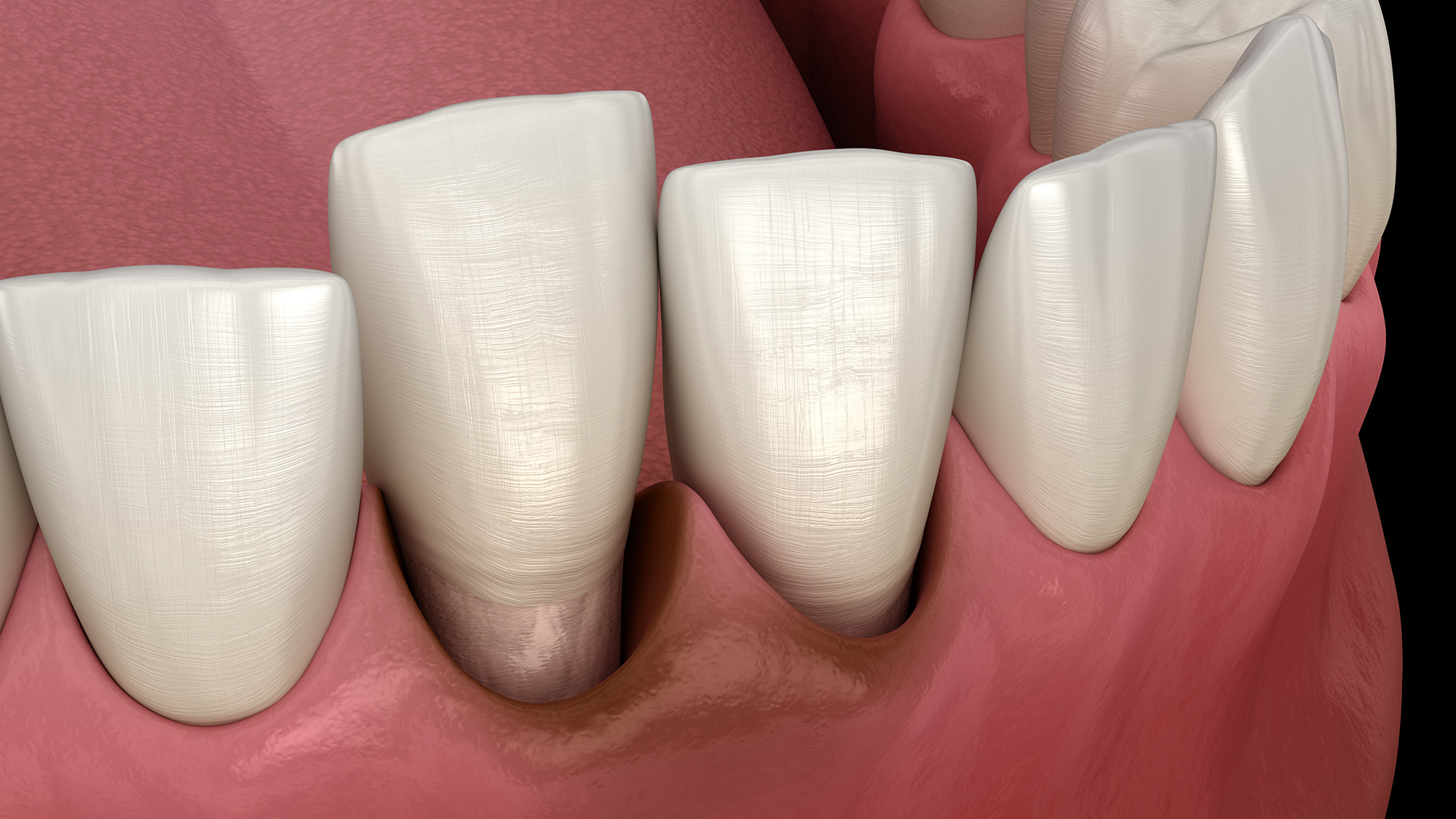 Gum disease Pensacola Periodontics and Implant Dentistry Pensacola, FL