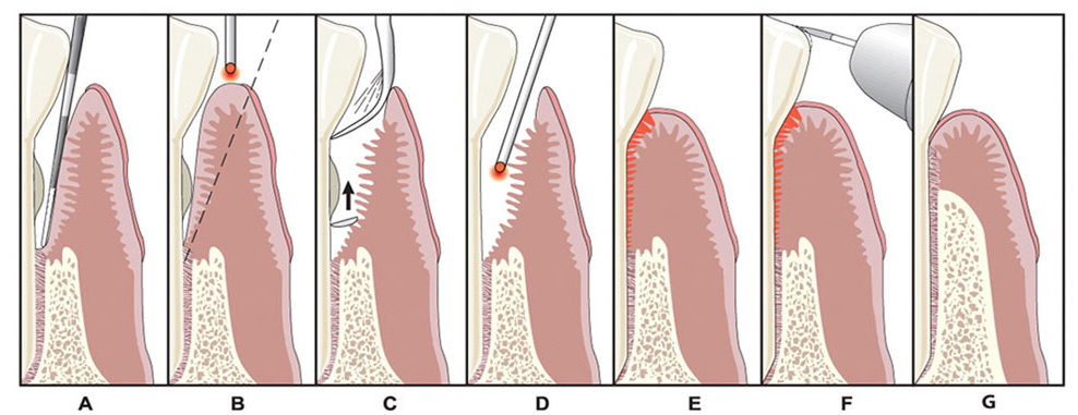 LANAP® Laser Treatment