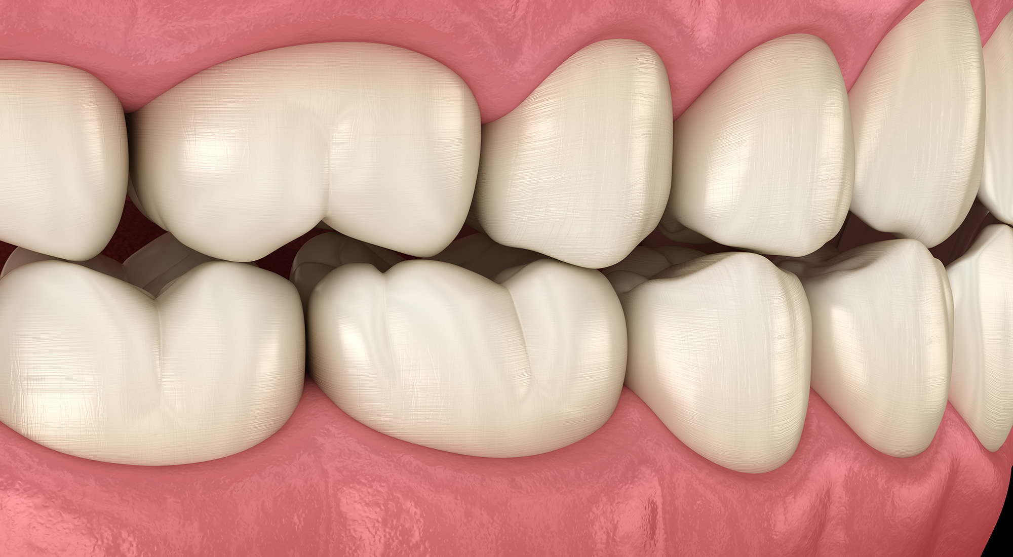 Occlusal Adjustment Pensacola Periodontics and Implant Dentistry Pensacola, FL