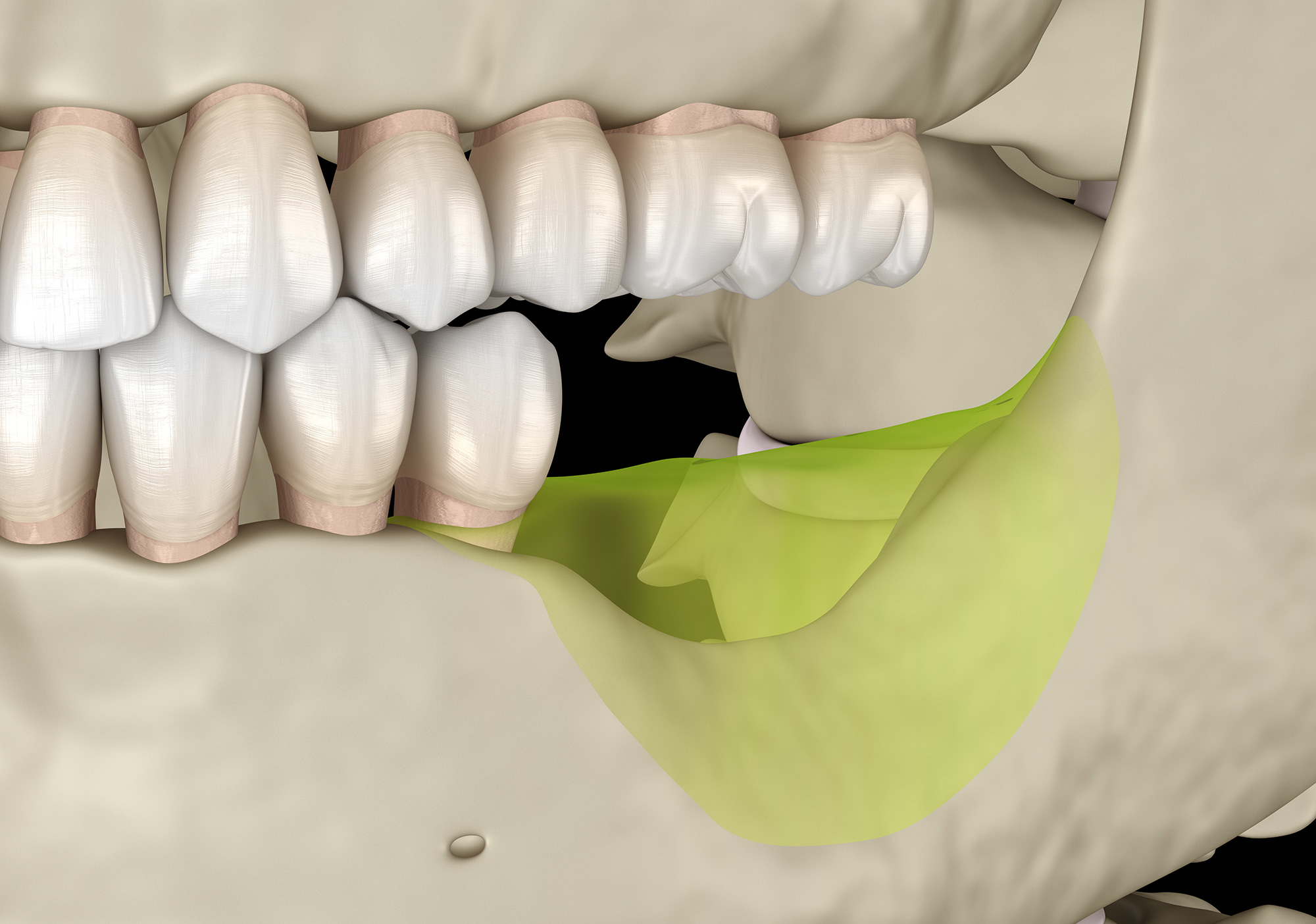 Ridge Augmentation Pensacola Periodontics and Implant Dentistry Pensacola, FL