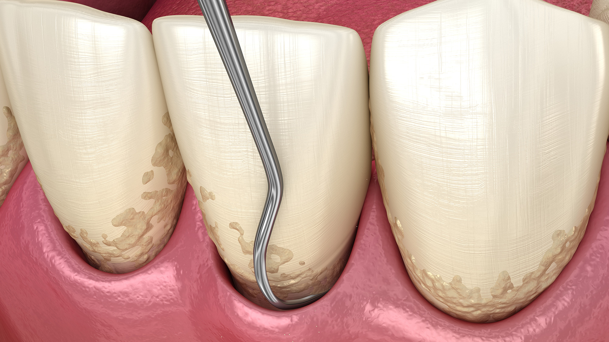 Scaling and Root Planing Pensacola Periodontics and Implant Dentistry Pensacola, FL