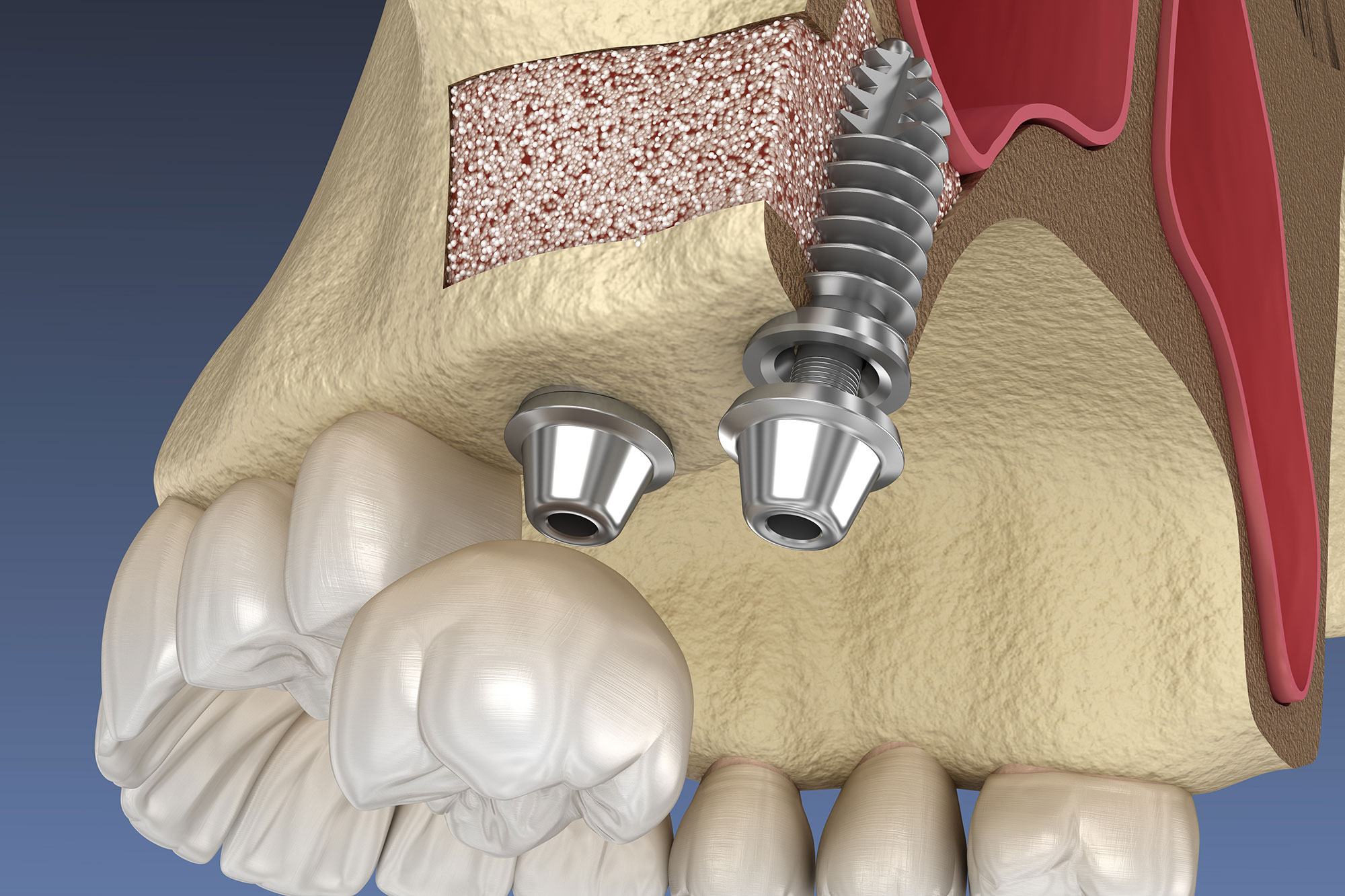 Sinus Lift Pensacola Periodontics and Implant Dentistry Pensacola, FL