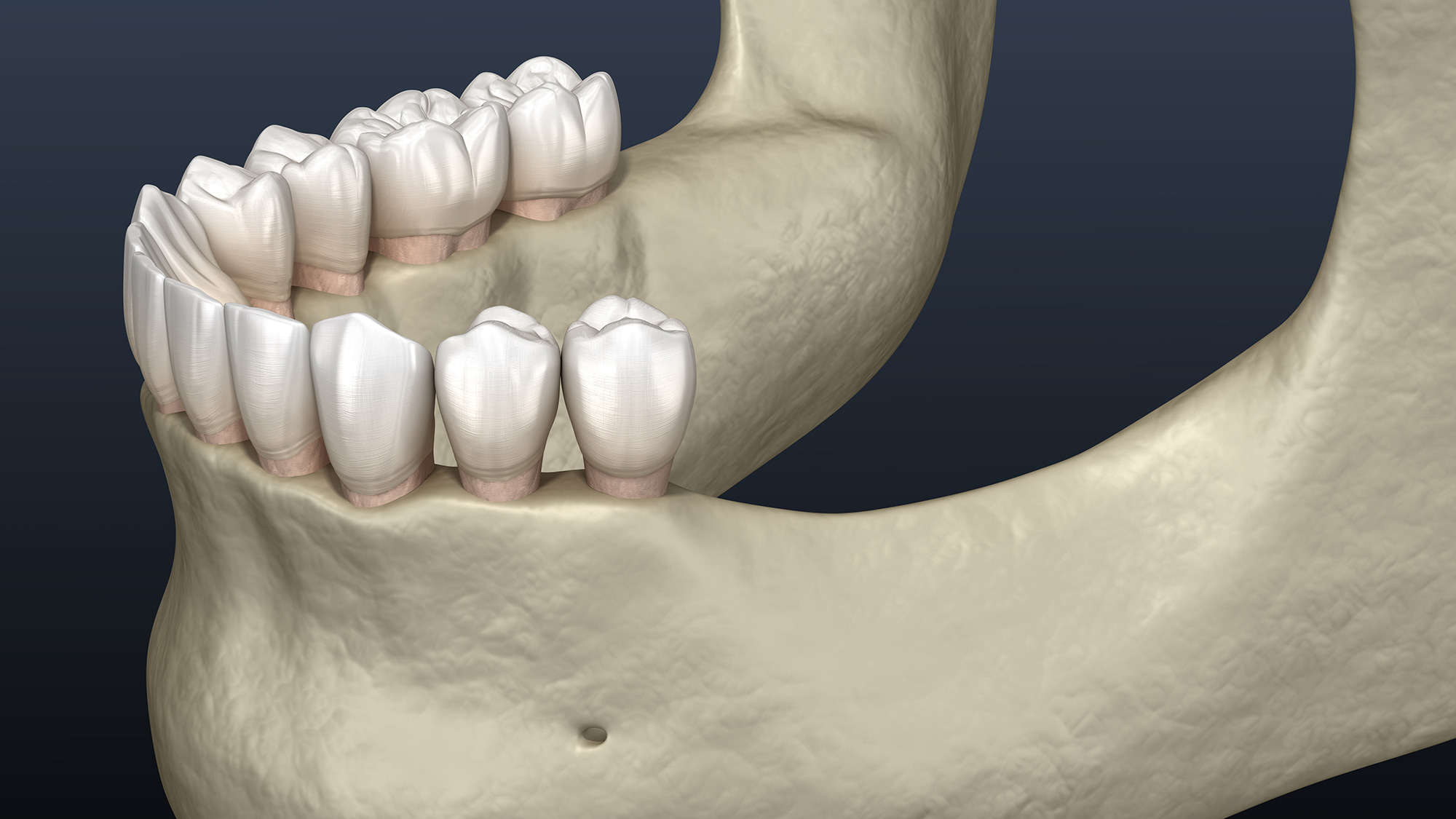 Tooth and Bone Loss Pensacola Periodontics and Implant Dentistry Pensacola, FL